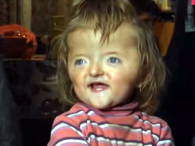 Girl with ‘Scary Skull’ Banned from Daycare over Fears of Scaring Other Kids