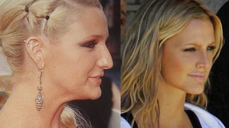 Here are some successful plastic surgeries of celebrities that transformed them for the better